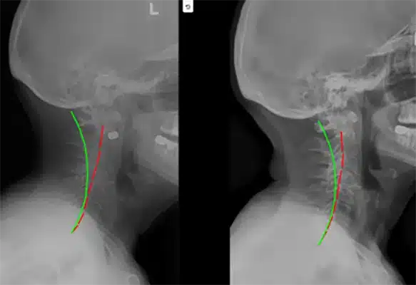 Chiropractic Traverse City MI X-Ray 1