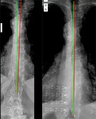 Chiropractic Traverse City MI X-Ray 2